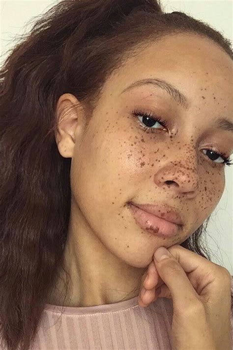 Why Brown Freckles Can Turn Black – Knowing The Causes And When To Seek Medical Advice | Justinboey