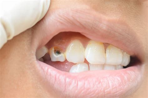 Tooth Broken Off at Gum Line No Pain: Here's What to Do - Go Fix Teeth