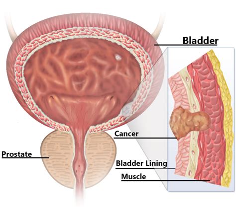 Bladder Cancer in Men, Dark Black Spots, and BCG Treatment | HealDove