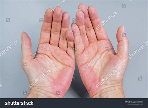 Bilateral Palmar Erythema Red Hands Palm Stock Photo 2213706863 | Shutterstock