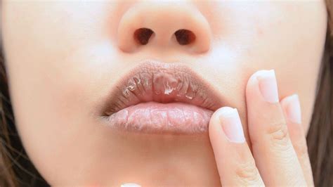 What causes dry lips, and how can you treat them? Does lip balm ...