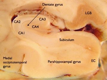 Parahippocampal epilepsy with subtle dysplasia: A cause of “imaging negative” partial epilepsy ...