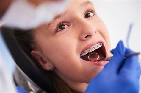 Average Cost Of Braces For Children: A Comprehensive Guide