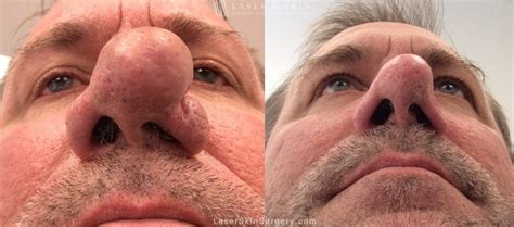 Rhinophyma Nose Treatment New York, NY | Laser Center