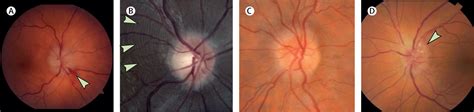 Optic neuritis and autoimmune optic neuropathies: advances in diagnosis and treatment - The ...