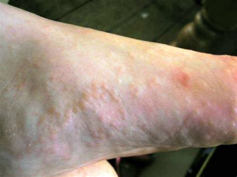 Dyshidrotic Eczema Dyshidrosis Overview Symptoms Caus - vrogue.co