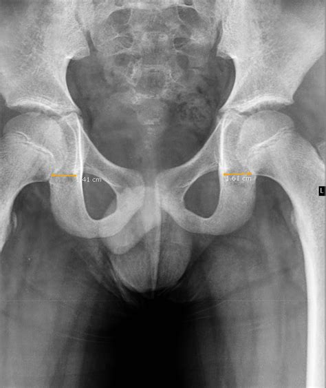 Transient Synovitis-Plain Film & MRI - Sumer's Radiology Blog