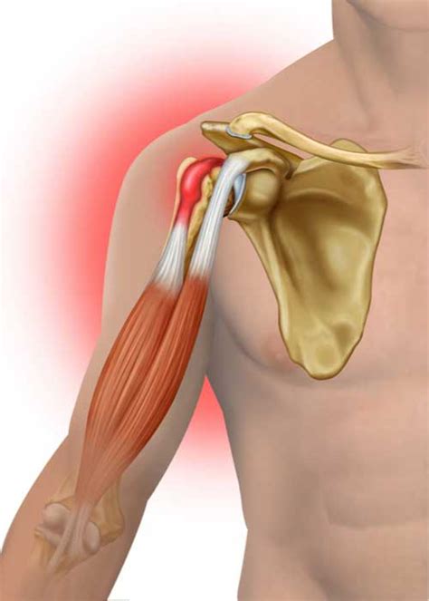 Biceps Muscle Injuries