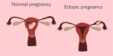 Ectopic Pregnancy Symptoms Blog - pregnancysymptoms