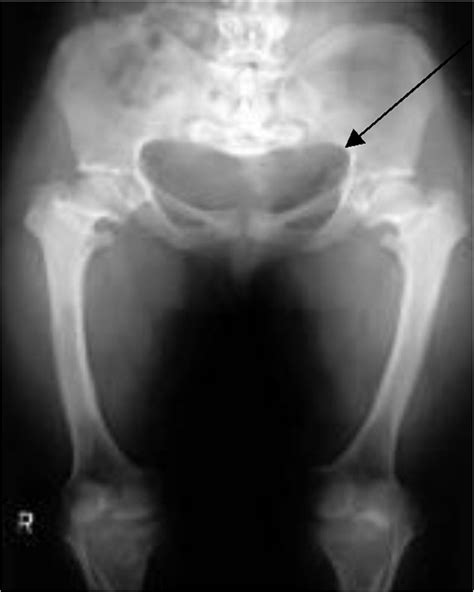 Increased Sacral Uptake on a Bone Scan with SPECT/CT in a Patient with Achondroplasia: Normal or ...