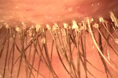 Blepharitis — Moyes Eye Center