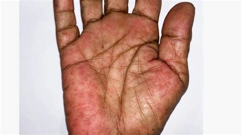 Rheumatoid arthritis rash – Artofit