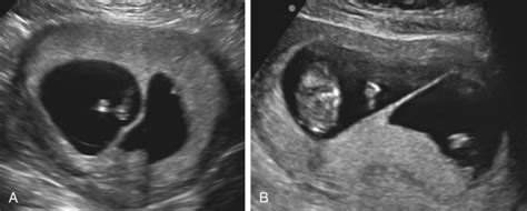 Dichorionic Diamniotic Twin Gestations | Radiology Key