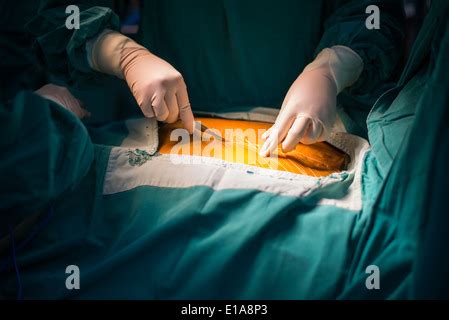 Median sternotomy incision Stock Photo - Alamy