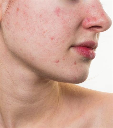 How To Get Rid Of Red Spots On Face: 6 Home Remedies And Tips Red Bumps ...