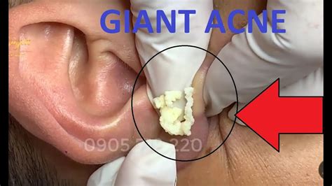 Benign ear cyst or tumor as related to Cholecystitis - Pictures