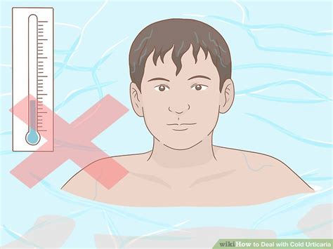 How to Deal with Cold Urticaria: 7 Steps (with Pictures) - wikiHow