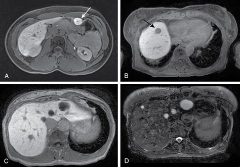 Benign focal liver lesions | Radiology Key