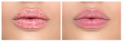 Lips. Close Up of Chapped, Cracked Lips, Dry Skin Problem with Mouth ...