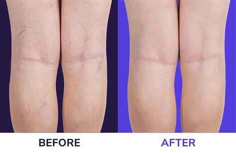 Varicose Veins | Nottingham Vascular Surgery