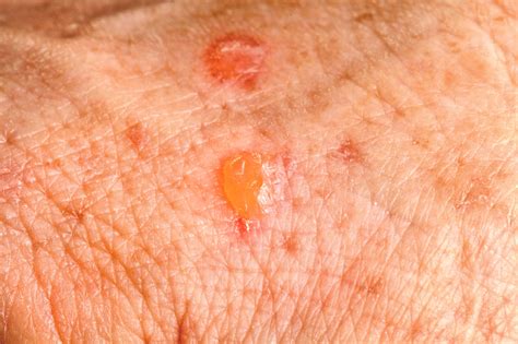 Pictures of Moles, Nevus, Actinic Keratosis, Psoriasis