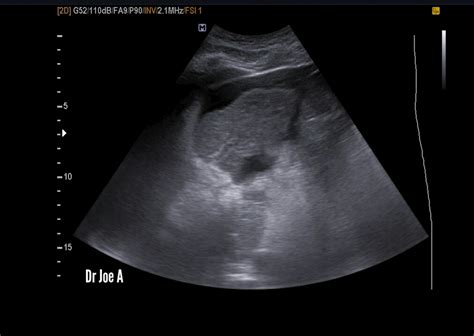 Ultrasound imaging: Cirrhosis-liver-ultrasound