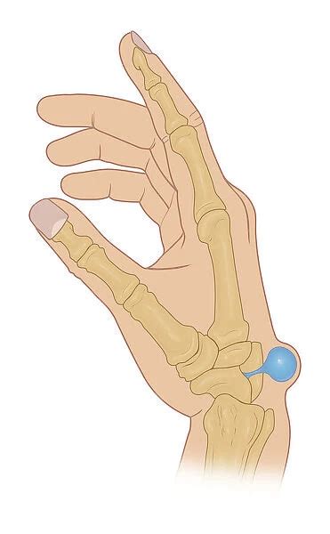 Illustration of dorsal wrist Ganglion cyst Our beautiful Wall Art and ...