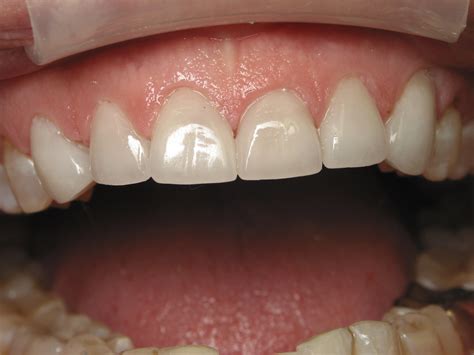 Tetracycline Stain and Worn Teeth from Grinding - Fort Dental