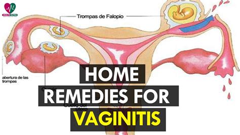 Home Remedies for Vaginitis - Health Sutra - YouTube