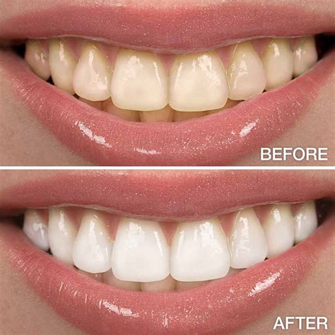 Whitening Teeth Egypt at Sandra Bleich blog