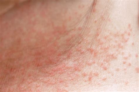 How to Get Rid of Heat Rash (Prickly Heat) - Riverchase Dermatology