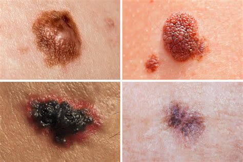 A Better Way to Distinguish Among Melanomas? - Contemporary Approaches ...