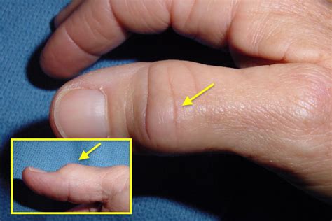 OSTEOARTHRITIS FINGER/THUMB (MP, PIP, DIP & IP) | Hand Surgery Source