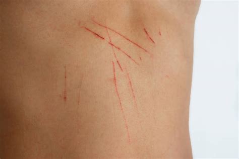 Scratched Skin Stock Photos, Pictures & Royalty-Free Images - iStock