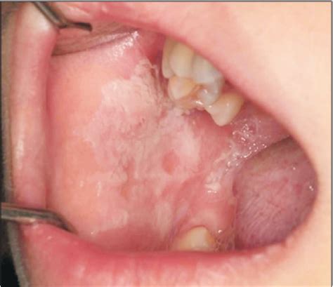 Frictional Keratosis Cheek