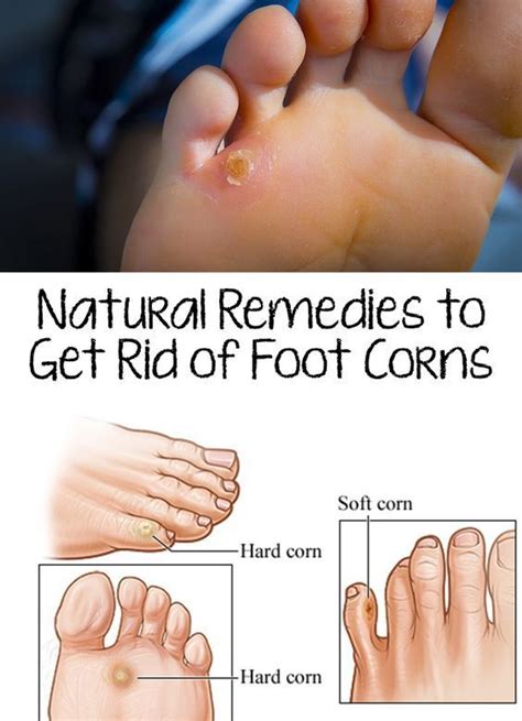 Foot Corns - Natural Remedies to Get Rid of Foot Corns (With images) | Corn on toe, Foot ...
