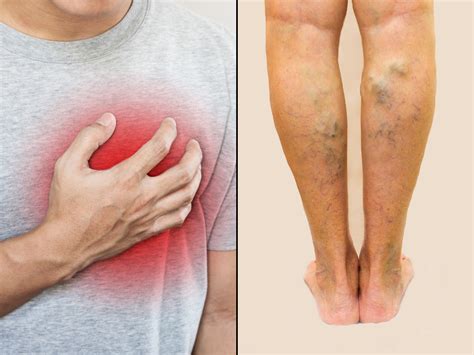 Heart disease symptoms: Swelling in your lower legs could be a warning sign