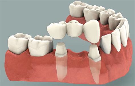 Dental bridges: The Pros and Cons of a Common Tooth Replacement ...