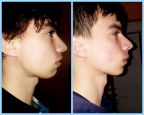 6 Month Mewing transformation (18M) : r/Mewing