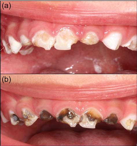 Clinical image (a) before, and (b) after using SDF. Note its dark color... | Download Scientific ...