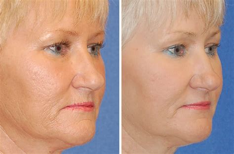 Erbium Laser Skin Resurfacing Patient – 4 | Napa Solano Plastic Surgery