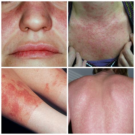 Lupus Skin Lesions From Sun - vrogue.co
