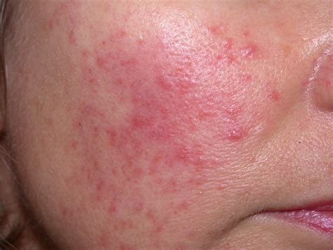 Facial Rashes: What’s the Diagnosis?