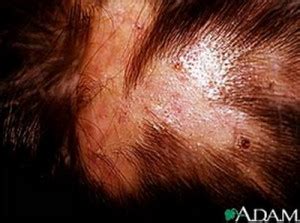 Infected Hair Follicle | Current Health Advice, Health Blog Articles and Tips