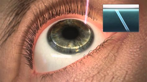 Eye Laser Treatment Youtube | darahrendah44