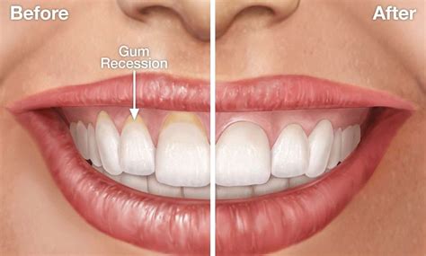 Receding Gums Stages