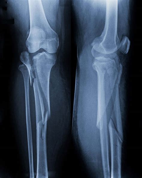 Knee Fracture Mumbai | Dr. Jay Shah