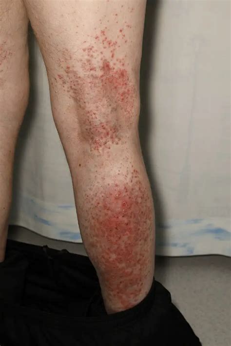 Itchy Skin Rash After Surgery Causes Diagnosis Treatment