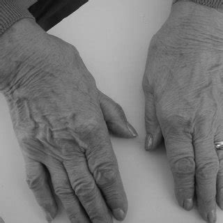 (PDF) Basal thumb arthritis