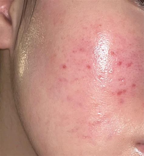 Is this pie?? (post inflammatory erythema) : r/acne